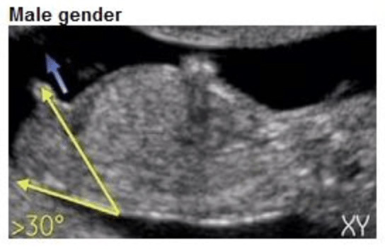 Echo met nub in hoek van 30+ graden, kenmerkend voor een jongen